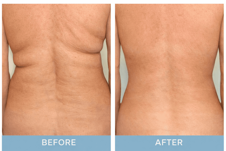 Before and after back contouring image showing smoother appearance and reduced fullness along the waistline