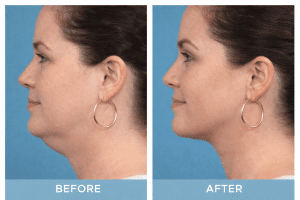 Before and after jawline contouring image showing reduced fullness under the chin